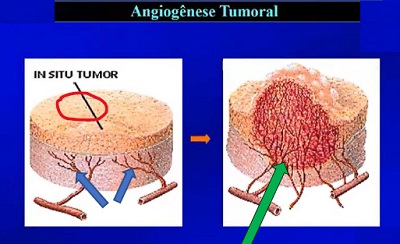 Tumeur cancéreuses